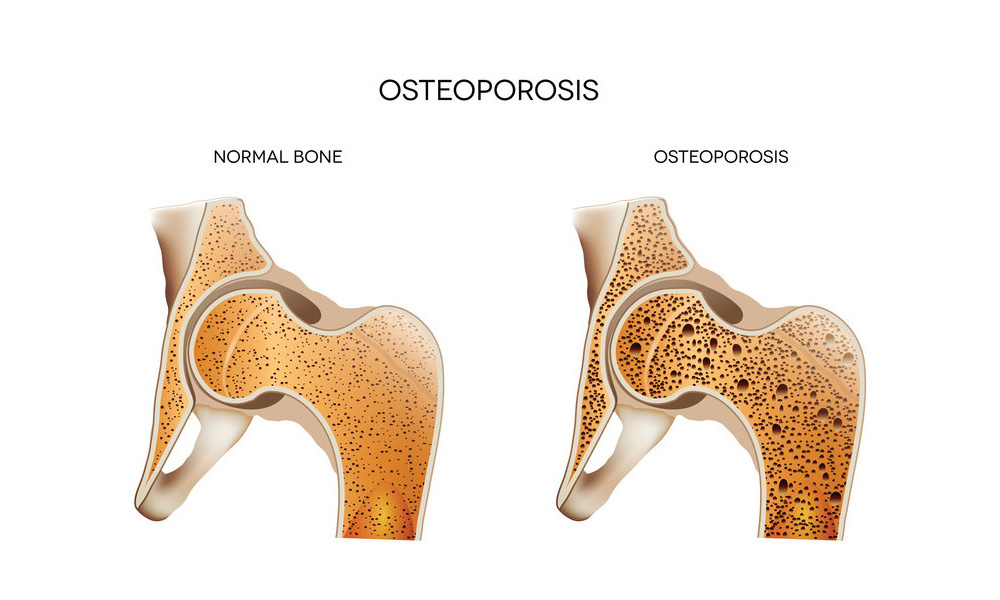 The Bone Density Epidemic