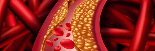 Understanding and Improving Your Cholesterol